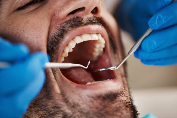 Best Emergency Treatment for Dental Infections or Abscesses in Linden, CA