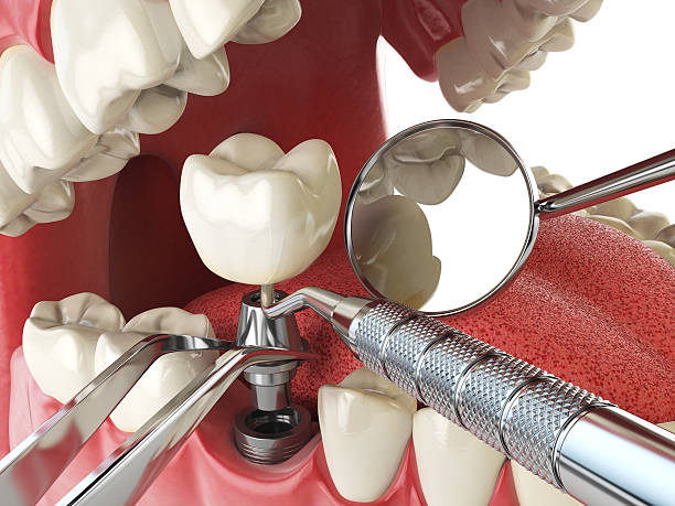 Best Emergency Treatment for Dental Infections or Abscesses in Linden, CA